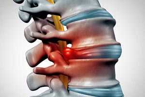 spondylosis treatment jalandhar